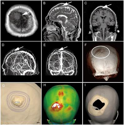 The first prospective application of AIGS real-time fluorescence PCR in precise diagnosis and treatment of meningioma: Case report